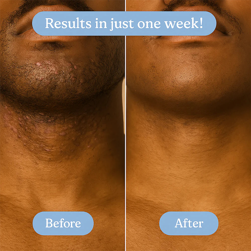 Ingrown Hair + Bump Control Serum – Visible results within a week.